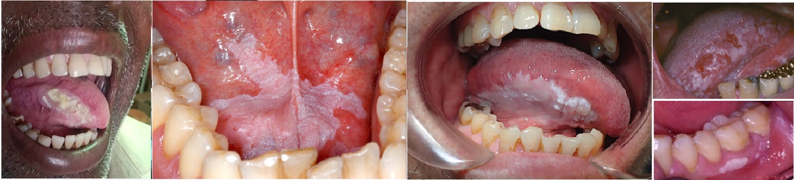 Don't Wait For A White Patch To Turn Into Cancer, Get Regular Dental Exams And Quit Tobacco To Prevent Oral Leukoplakia